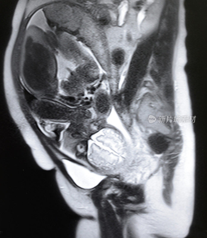 胎儿和孕妇MRI T2体重图像